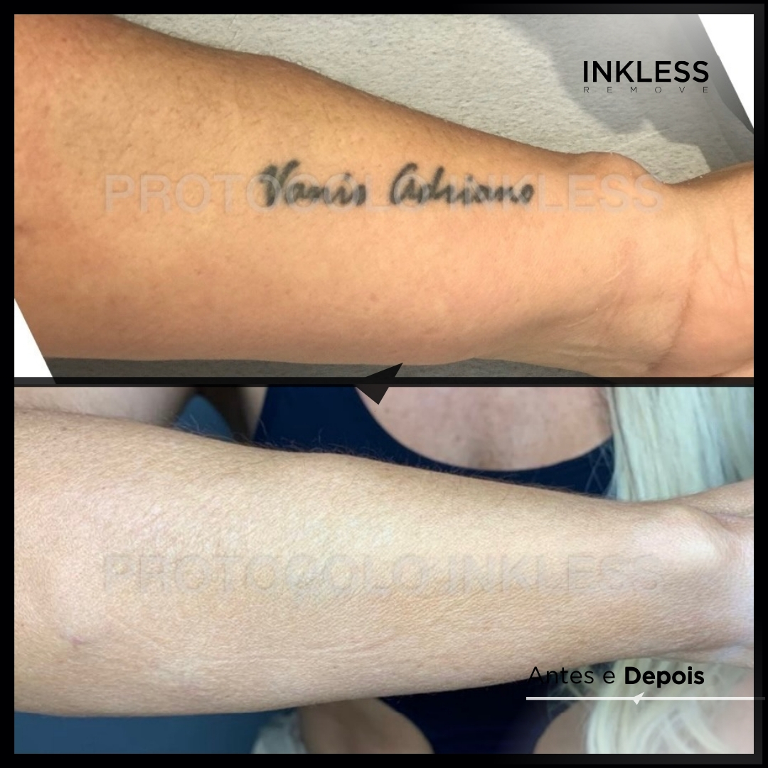 Resultado de remoção INKLESS - caso 1