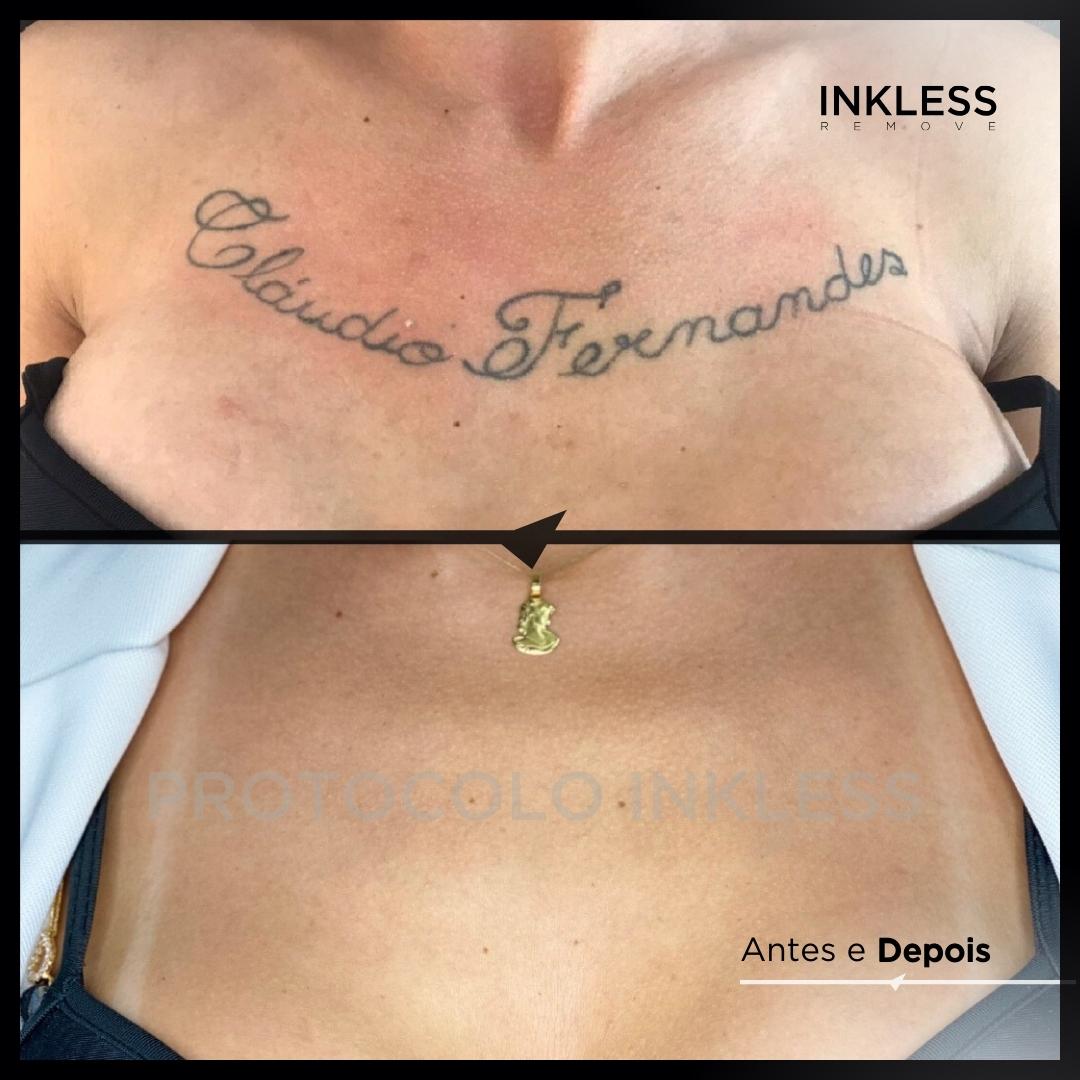 Resultado de remoção INKLESS - caso 10