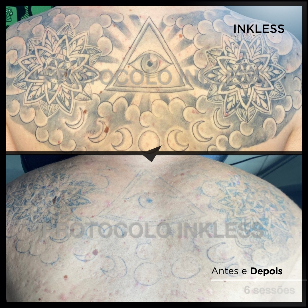 Resultado de remoção INKLESS - caso 2