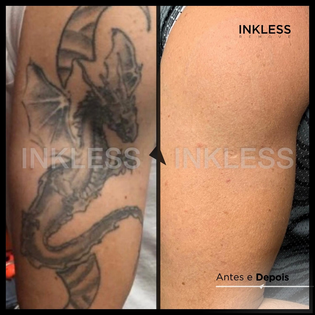 Resultado de remoção INKLESS - caso 6