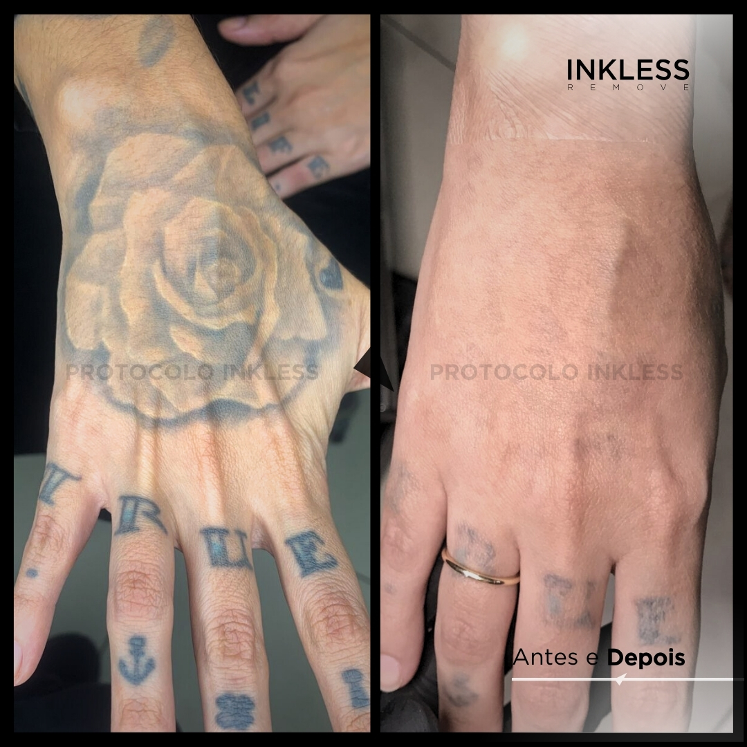 Resultado de remoção INKLESS - caso 8